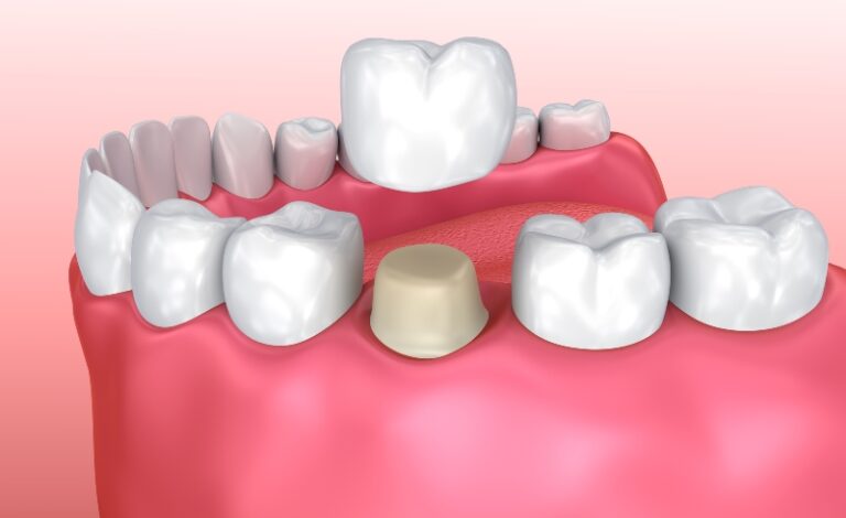 what-to-do-if-your-temporary-crown-fell-off-by-tempe-smiles