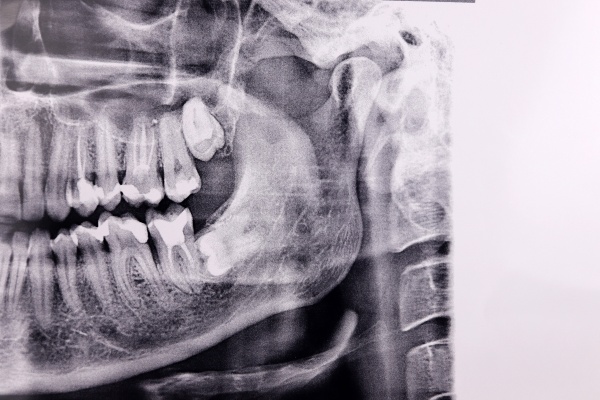 Image showing CT Imaging of wisdom tooth in Tempe, AZ