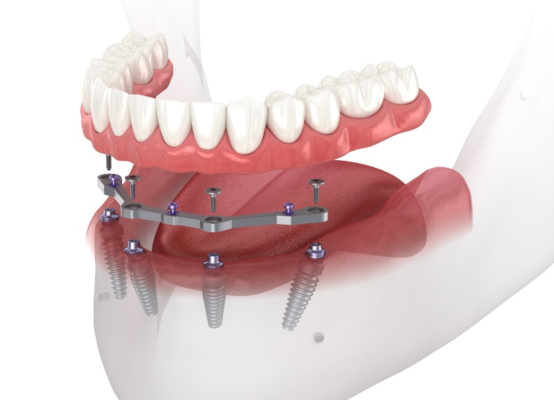  3D illustration of All-on-4 denture procedure in Tempe, AZ