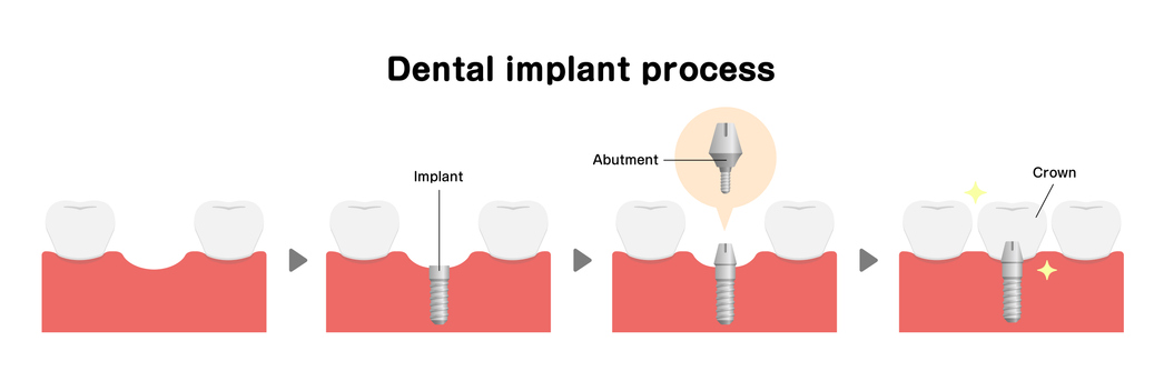 Graphical representation of dental implant surgery in Tempe, AZ, by Tempe Smiles